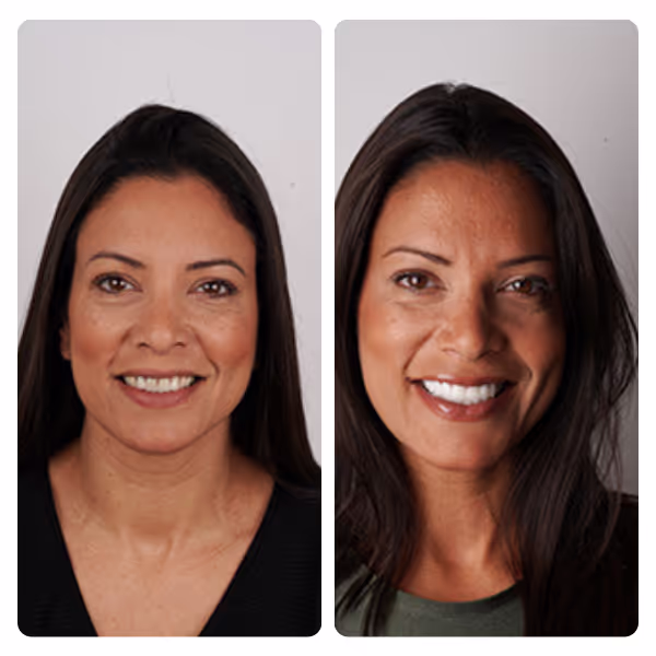 Hollywood Smile in Turkey